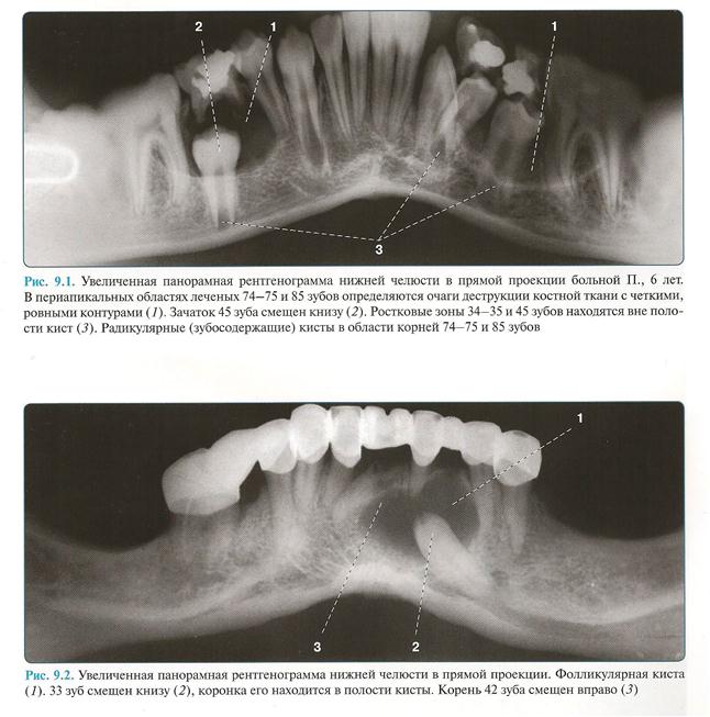 Реферат: Радикулярная зубосодержащая киста